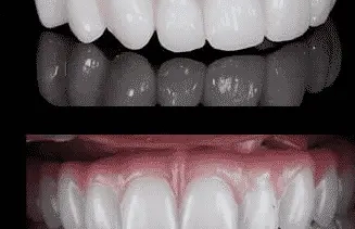 All-on-4 Dental Implants