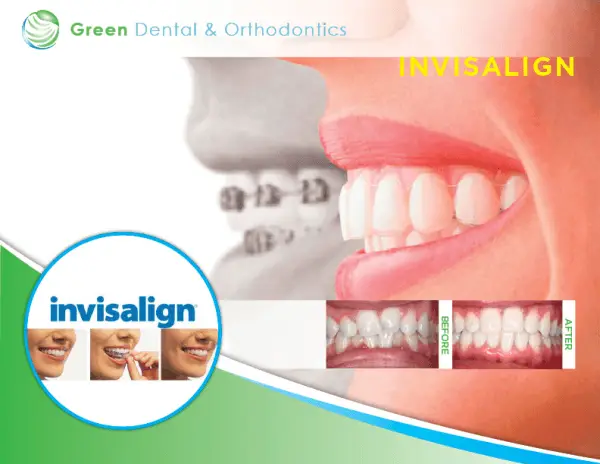 5 Reasons to Choose Invisalign®