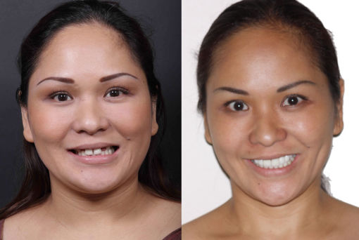 Ten porcelain veneers and gum lift to give patient a feminine smile