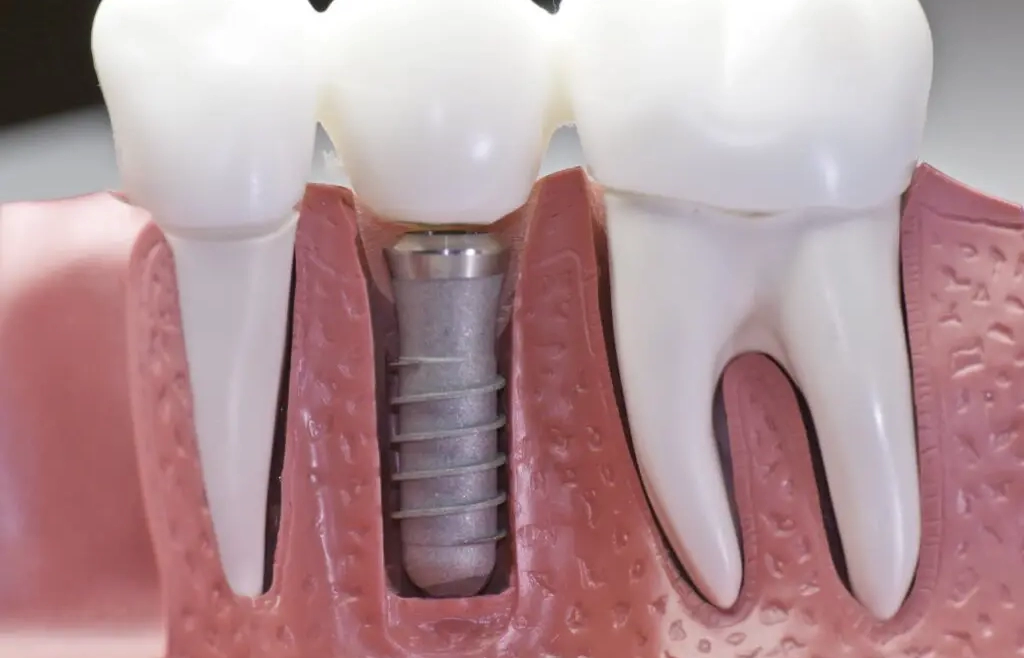 9 Things You May Not Know About Dental Implants