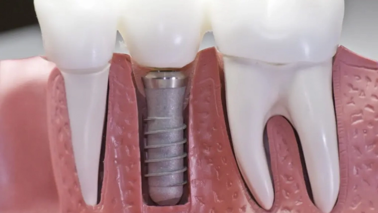 9 Things You May Not Know About Dental Implants