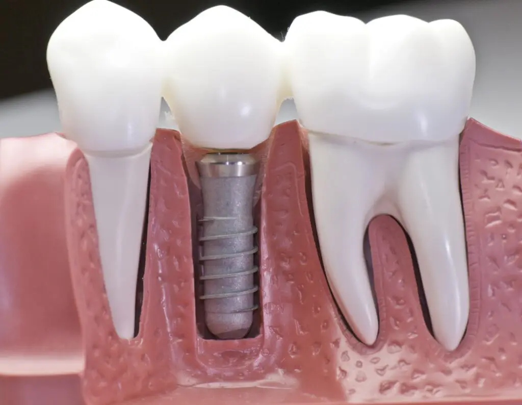 Dental Implant Recovery Process Facts - Sherman Oaks Dentist