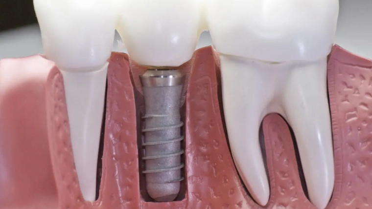 A Periodontist and Your Dental Implants
