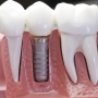 Why dental implants are becoming popular?