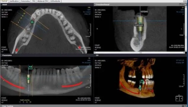 Cone Beam CT Scan Will Improve Dental Implant Placement