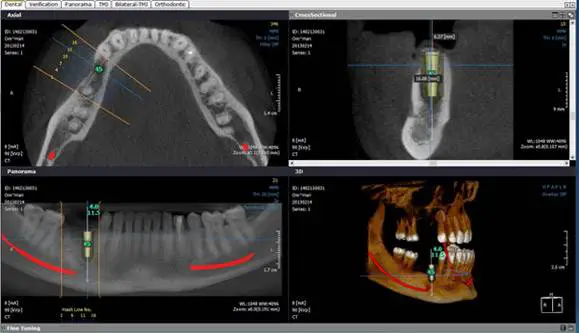 Cone Beam CT Scan Will Improve Dental Implant Placement