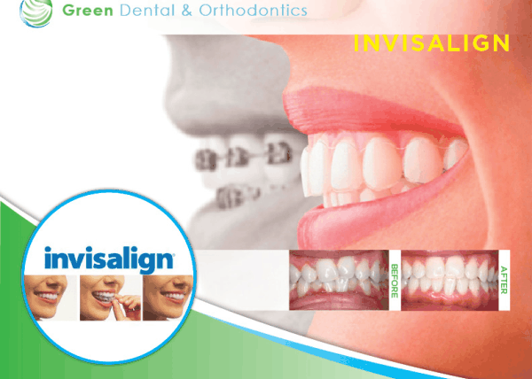 5 Reasons to Choose Invisalign®