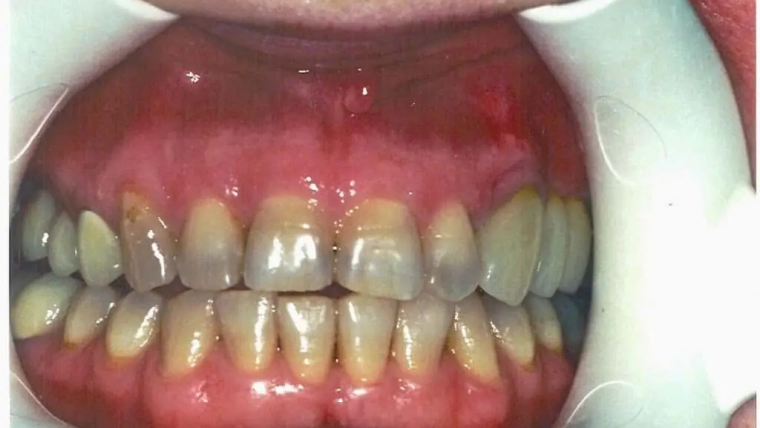 Jawbone Health: Preserving Dental Impact below the Gum Line
