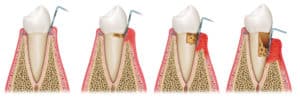 Gum Disease (Periodontal Disease): Answered By A Dentist