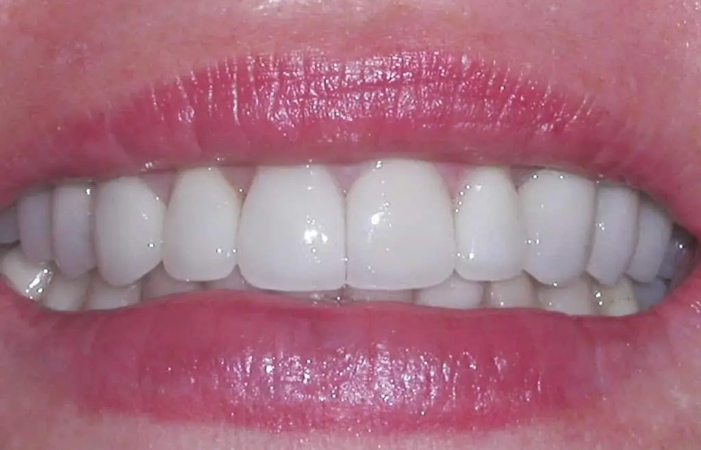 6 Tips to avoid plaque and tartar for better gums health