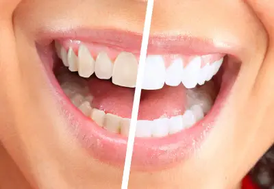 Teeth Whitening