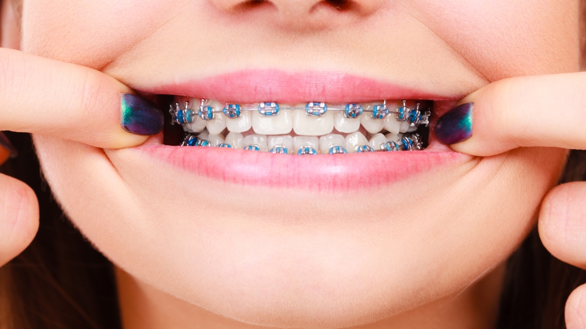 Preparing your child for dental braces