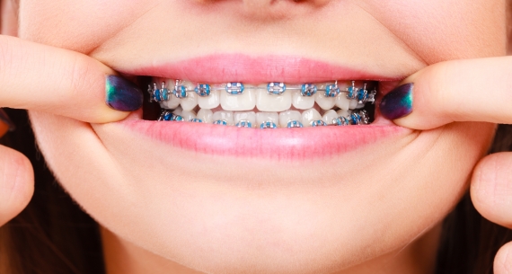 Preparing your child for dental braces