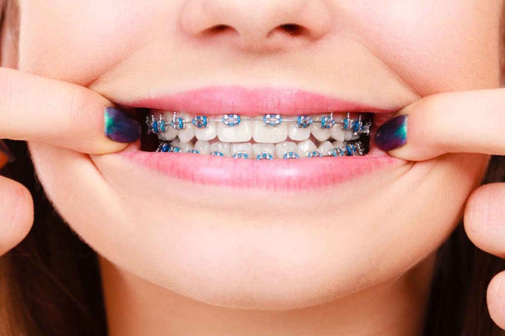 dental brace treatment