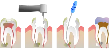 Root Canal Infections: Identifying Symptoms & Seeking Treatment