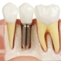 Why CBCT Imaging is Important in Dental Implant Planning