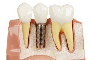 Why CBCT Imaging is Important in Dental Implant Planning