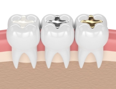 Frequently asked questions about cavities and dental fillings