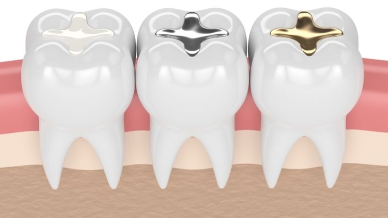 Frequently asked questions about cavities and dental fillings