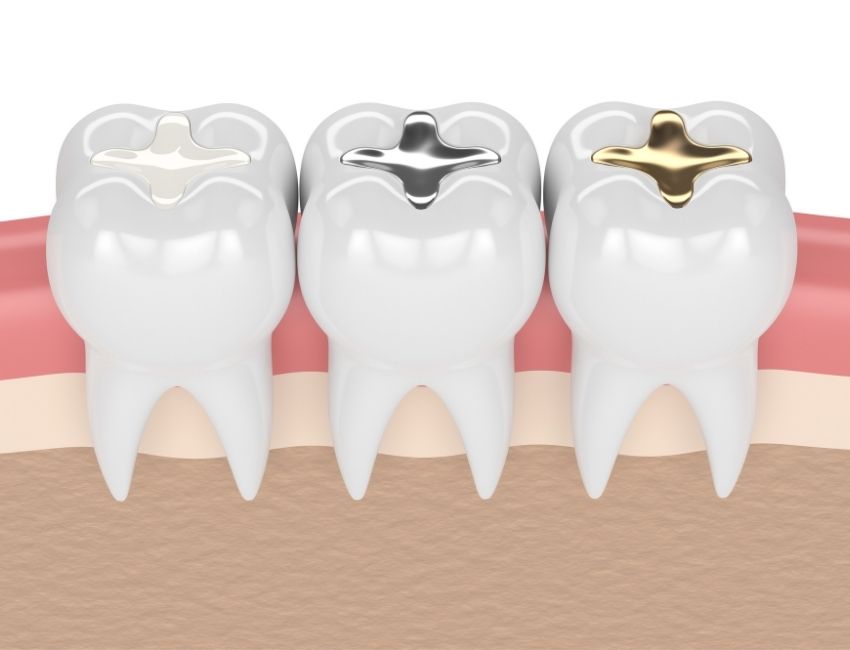dental fillings for cavities: By dentist in Sherman Oaks