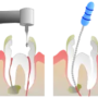 When is the right time for a root canal treatment?