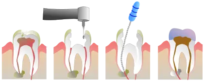 When is the right time for root canal treatment