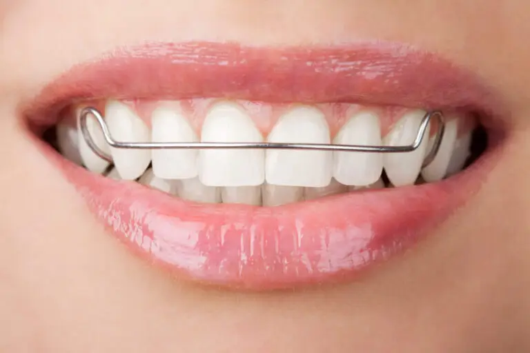 after orthodontics - retainers