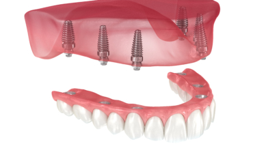 Tips to Choose The Right Dental Implant Specialist