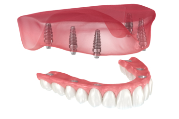 Tips to Choose The Right Dental Implant Specialist