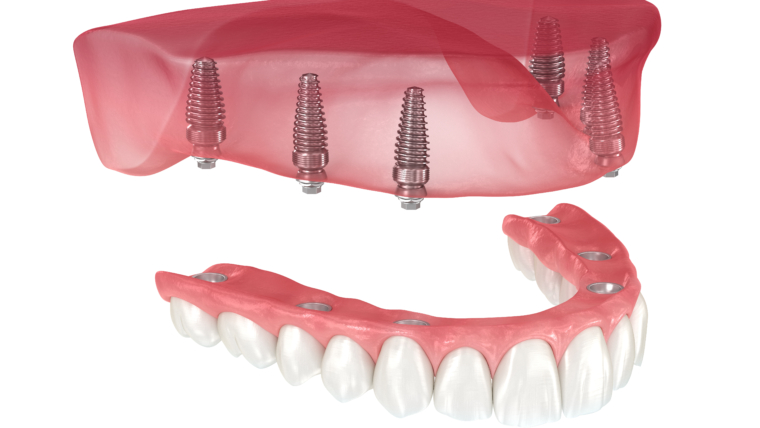 All-on-4 Dental Implants: Full Arch Replacement for Total Rehabilitation