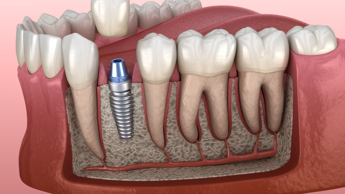 Few Facts To Know About Dental Implants