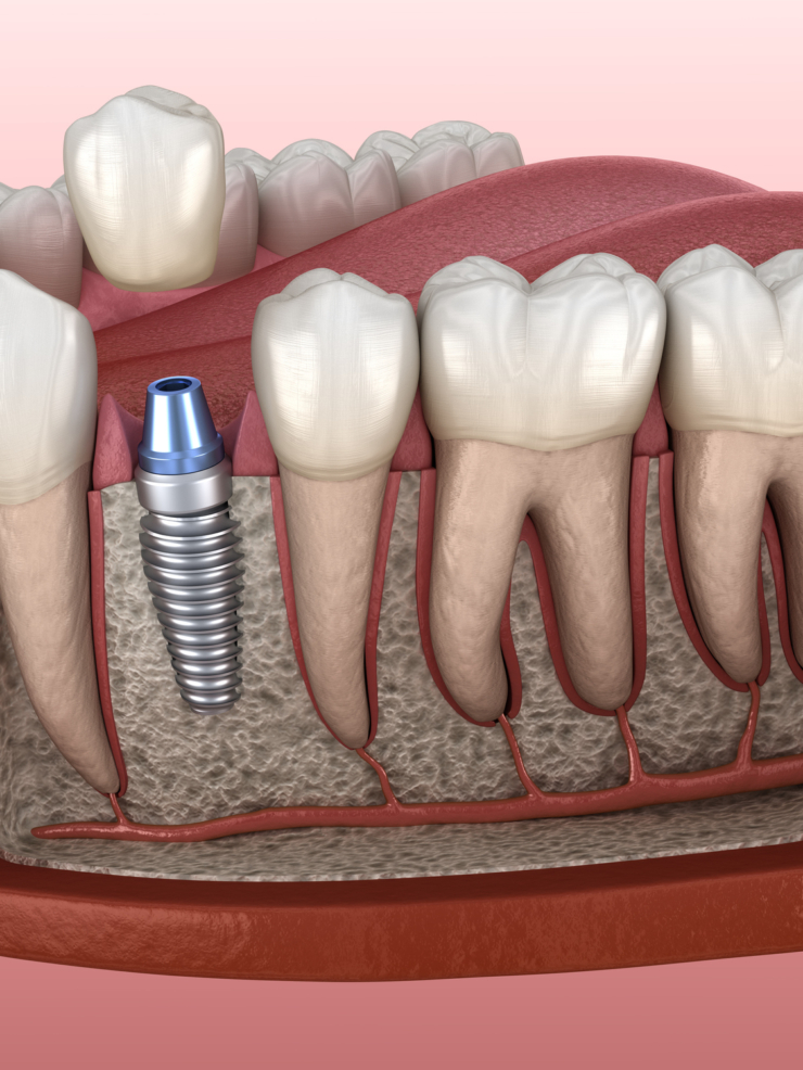 Dental Implants - Premolar tooth crown installation over implant abutment. 