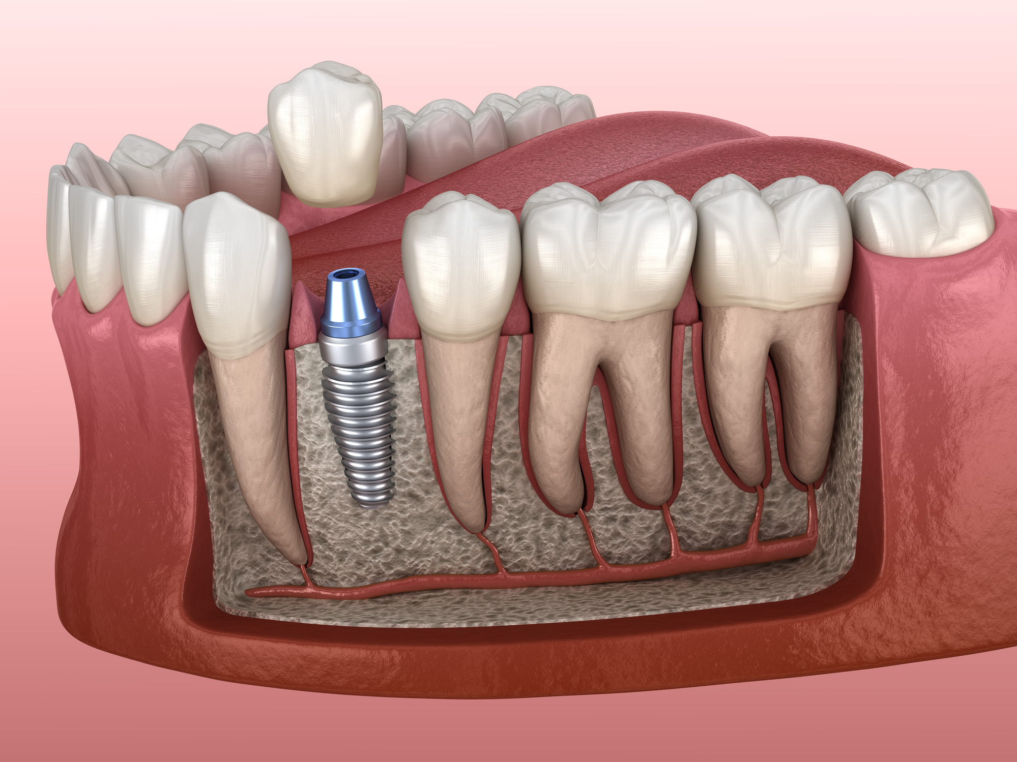Dental Implants - Premolar tooth crown installation over implant abutment.