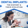 The History of Dental Implants & Their Evolution