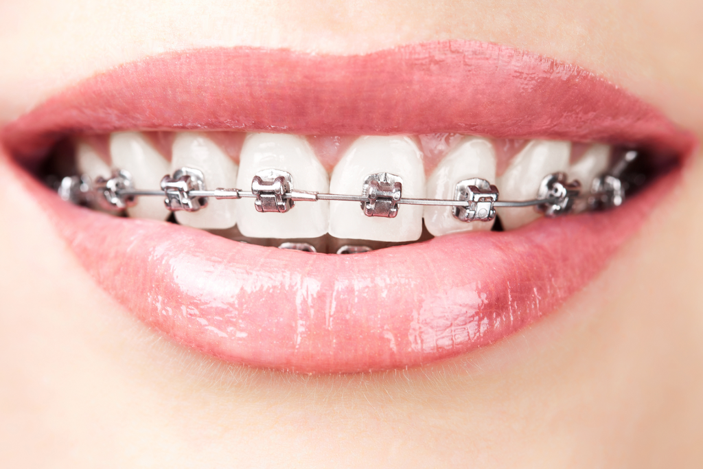 Challenges with braces Sherman Oaks California