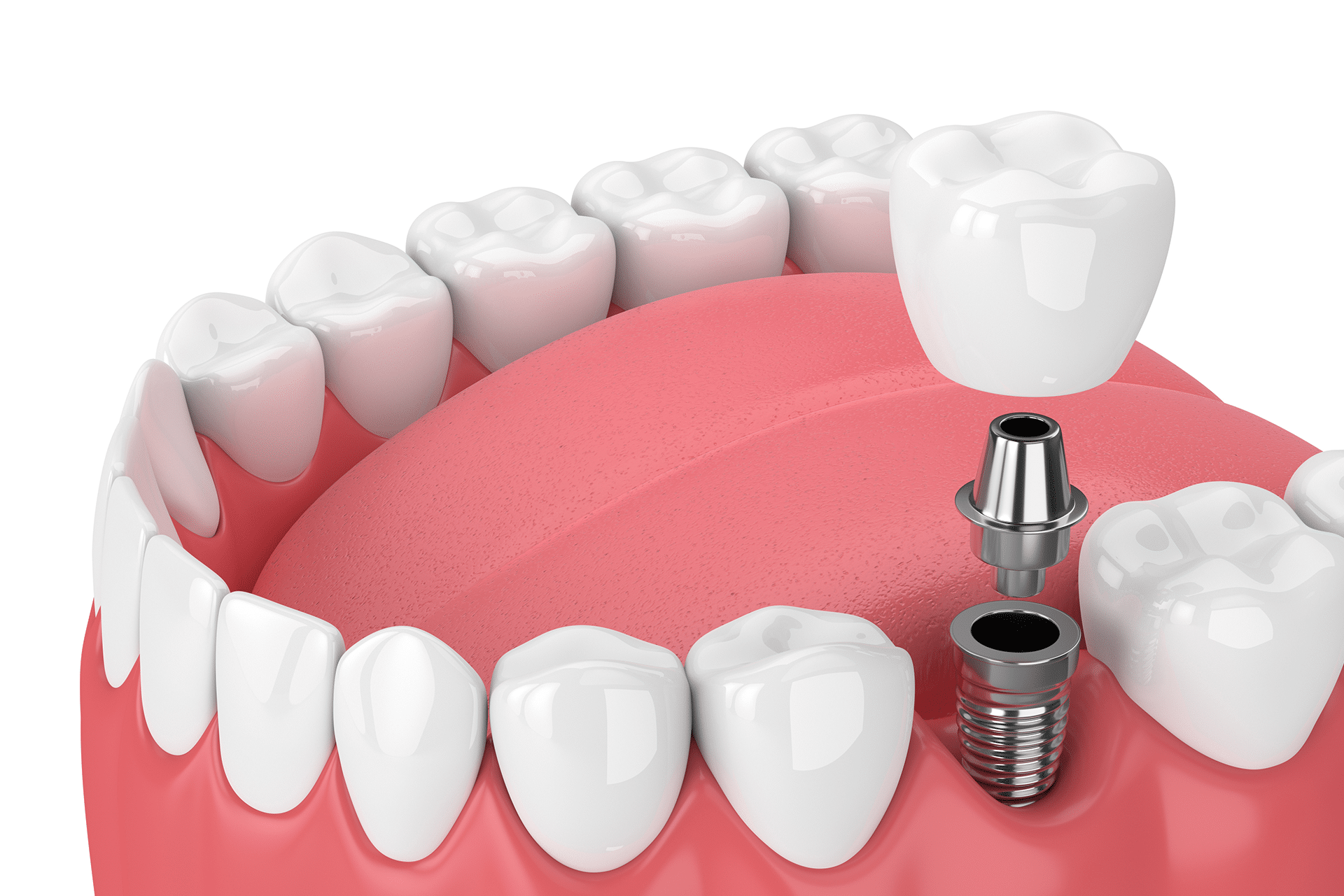 Sherman Oaks Dental Implant Complication