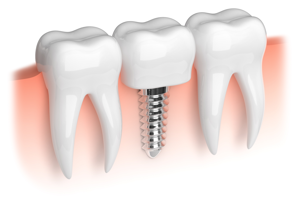 Choosing a dental implant specialist