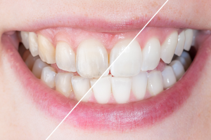 Tooth Enamel Sherman Oaks California