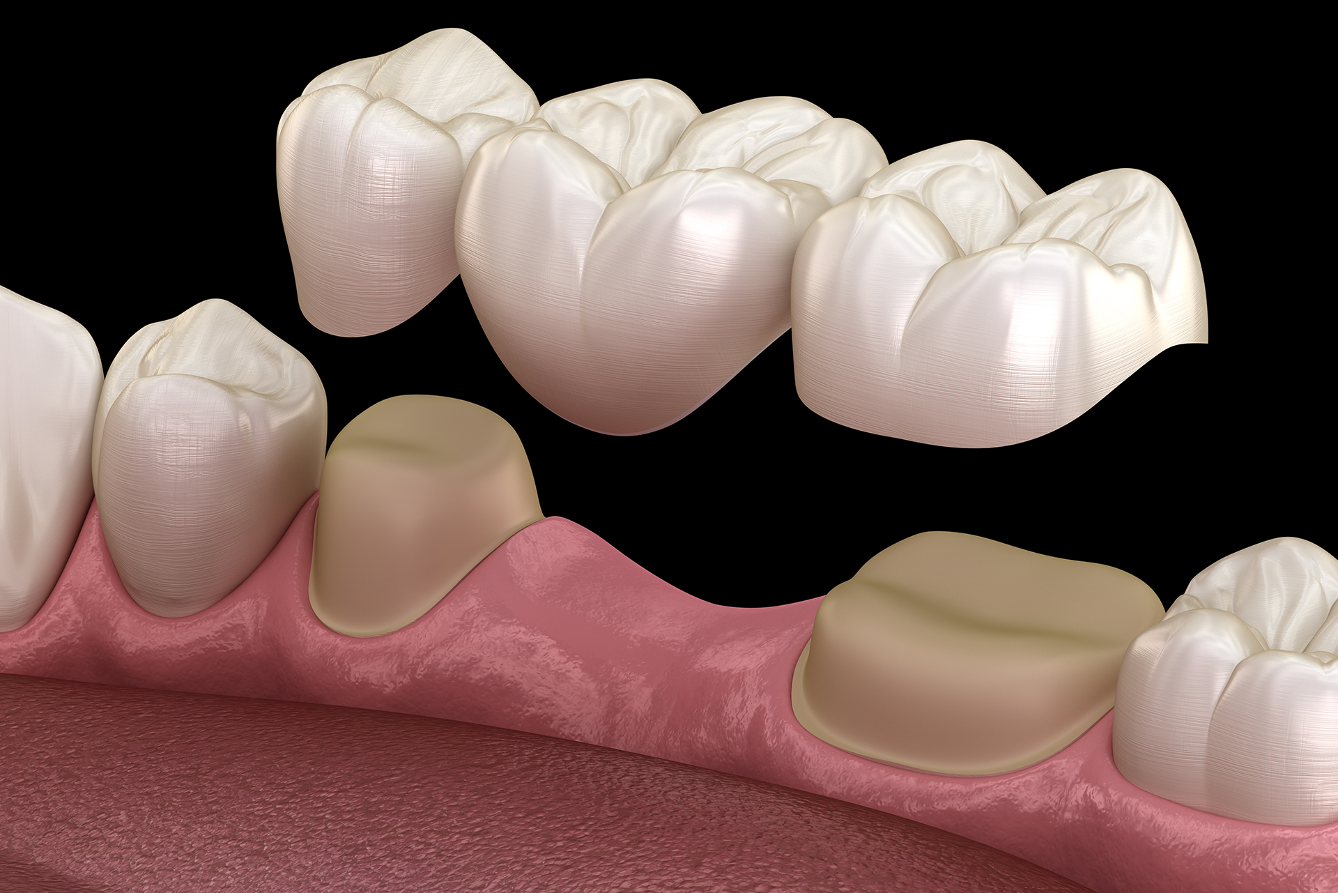 dental bridges vs dental implants