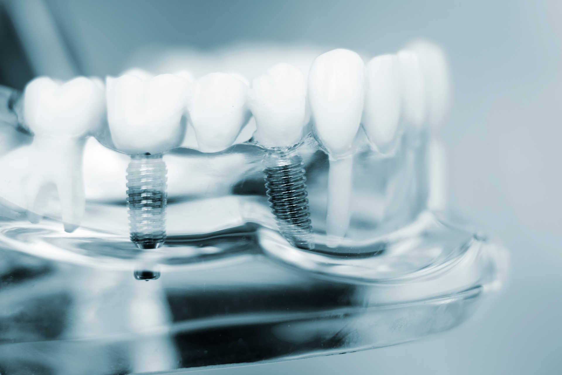 Traditional vs. mini dental implants