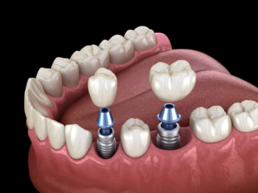 Dental Implants and Bone Health: Exploring the Connection