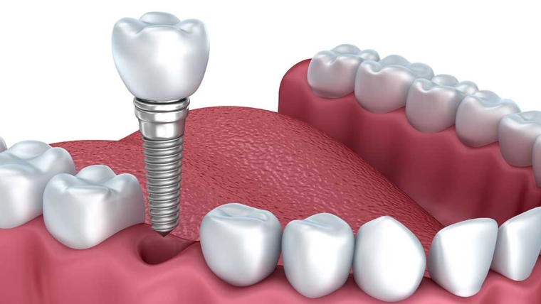 Dental Implants for Single Tooth Replacement: Is It Right For You?