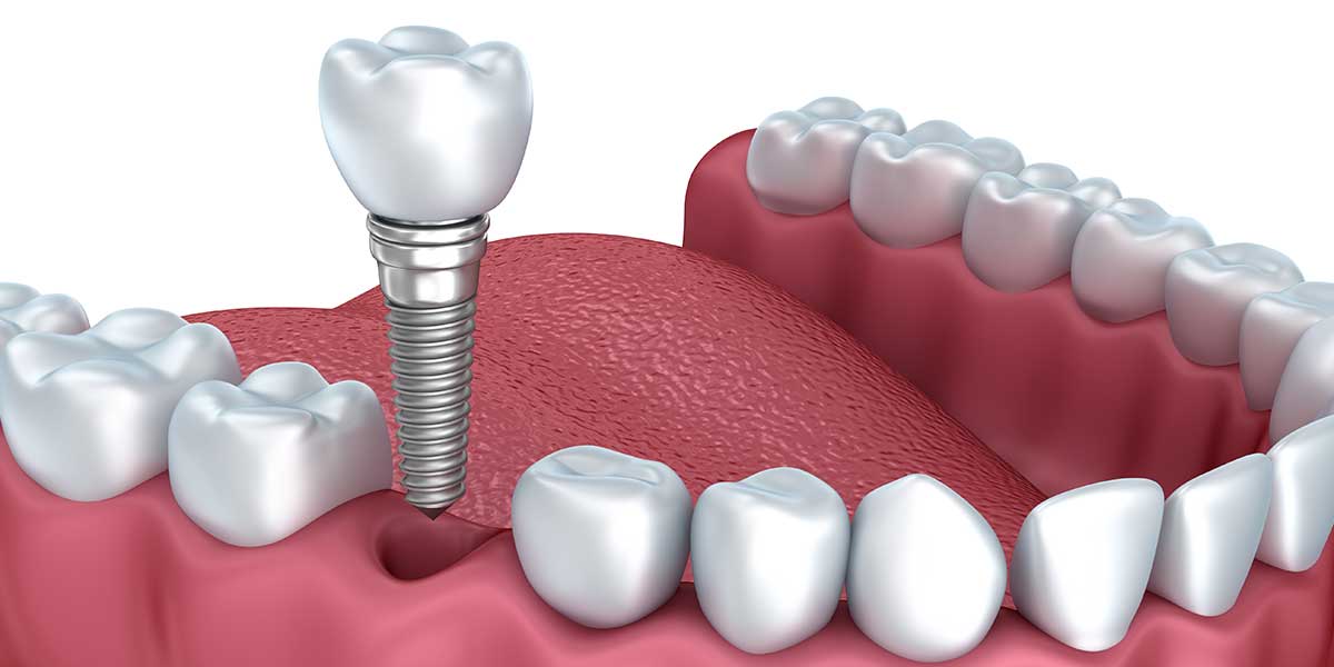 Implants for Single Tooth Replacement