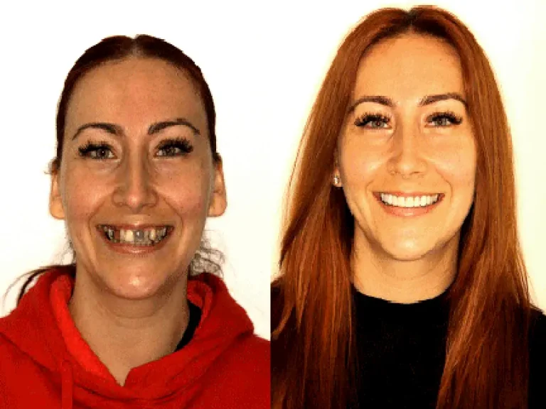 Sherman Oaks Dentist Before and After photo 03