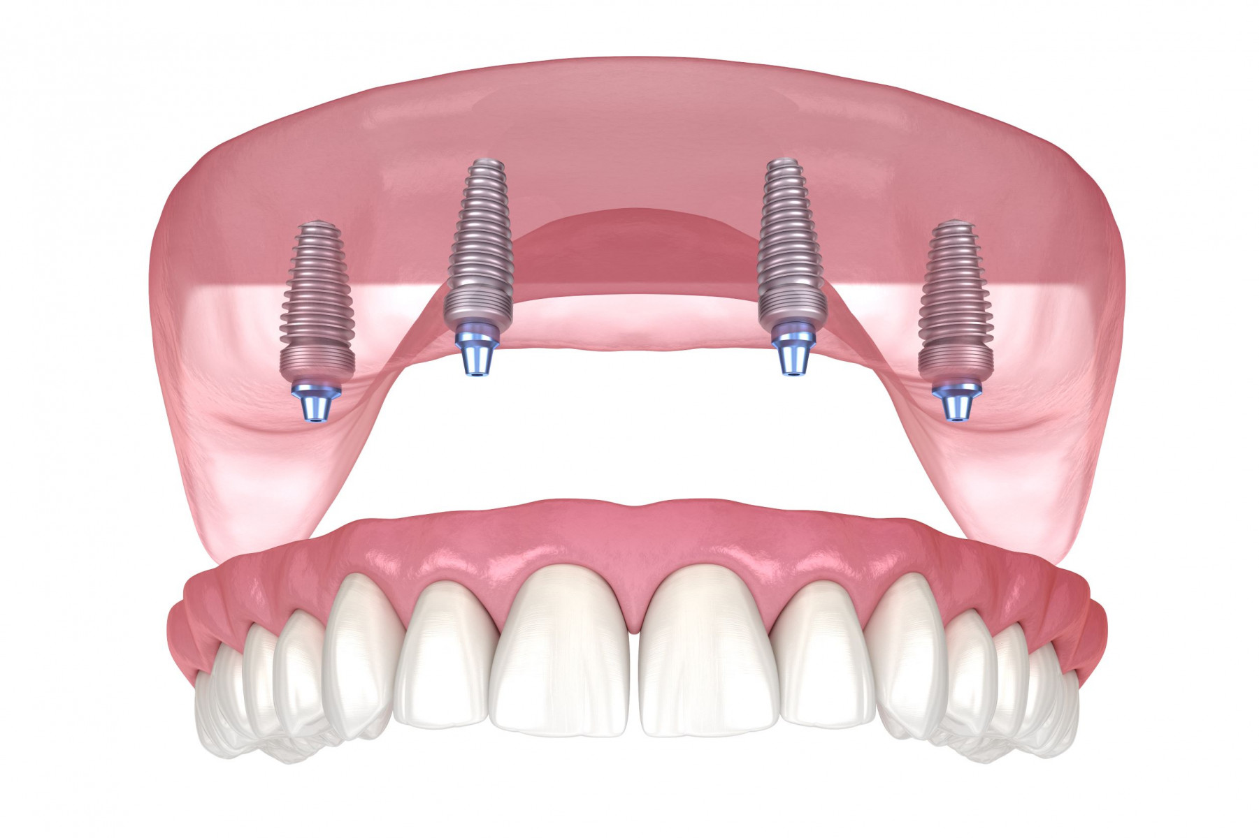 Sherman Oaks Dental Implant Specialists