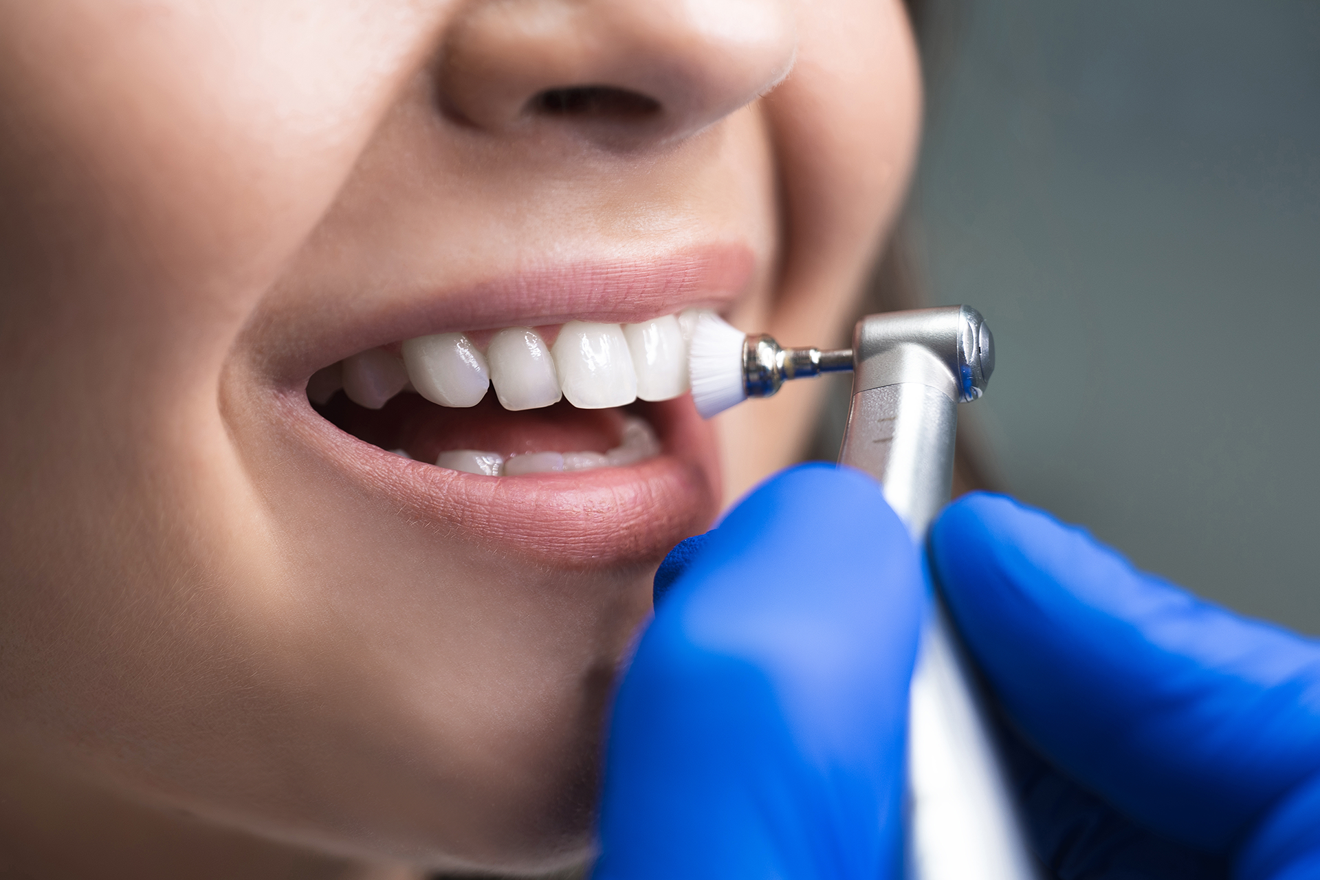 Dental Cleaning Sherman Oaks