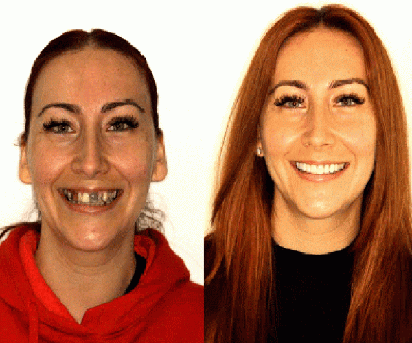 Before-After--dental-implants2