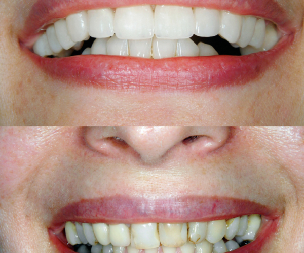 Before and after Smile design dental procedure photos . Selective soft focus.You can find more dental related images like this one here :