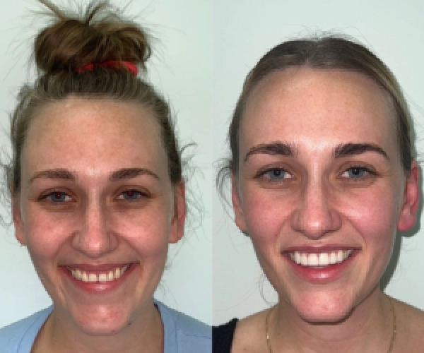 Dental-Implants-before-after-Kim-300x300