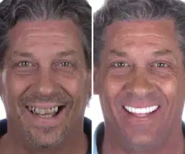 Dental-Implants-before-after-Masoud-300x300